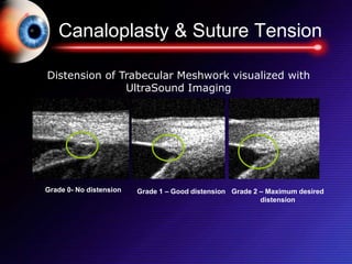 Canaloplasty & Suture Tension
Grade 0- No distension Grade 1 – Good distension Grade 2 – Maximum desired
distension
Distension of Trabecular Meshwork visualized with
UltraSound Imaging
 