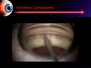 Ab-Interno Canaloplasty
 
