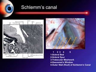 Schlemm’s canal
1 2 3 4 5
1-Scleral Bed
2-Scleral Spur
3-Trabecular Meshwork
4-Descemet’s Window
5-Outer Wall (Roof) of Schlemm’s Canal
 