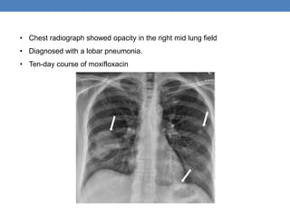 • Chest radiograph showed opacity in the right mid lung field
• Diagnosed with a lobar pneumonia.
• Ten-day course of moxifloxacin
 