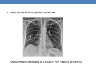 • nasal examination showed no involvement.
Granulomatous polyangiitis as a cause of non resolving pneumonia
 