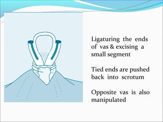 Ligaturing the ends
of vas & excising a
small segment

Tied ends are pushed
back into scrotum

Opposite vas is also
manipulated
 
