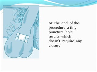 At the end of the
procedure a tiny
puncture hole
results, which
doesn’t require any
closure
 
