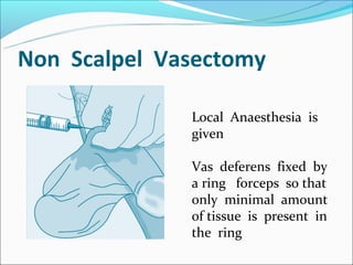 No- scalpel vasectomy