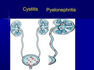 PyelonephritisCystitis
 