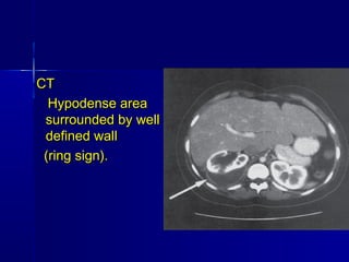 CTCT
Hypodense areaHypodense area
surrounded by wellsurrounded by well
defined walldefined wall
(ring sign).(ring sign).
 