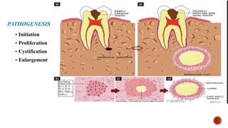 NON SURGICAL MANAGEMENT OF RADICULAR CYST.pptx