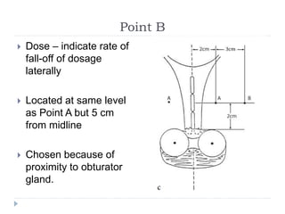Point B
 Dose – indicate rate of
fall-off of dosage
laterally
 Located at same level
as Point A but 5 cm
from midline
 Chosen because of
proximity to obturator
gland.
 