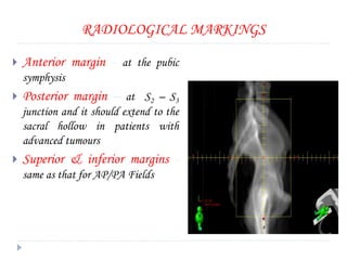 RADIOLOGICAL MARKINGS
 Anterior margin - at the pubic
symphysis
 Posterior margin – at S2 – S3
junction and it should extend to the
sacral hollow in patients with
advanced tumours
 Superior & inferior margins -
same as that for AP/PA Fields
 