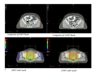 Composite of 6MV beam
6MV color wash
Composite of 15MV beam
15MV color wash
 