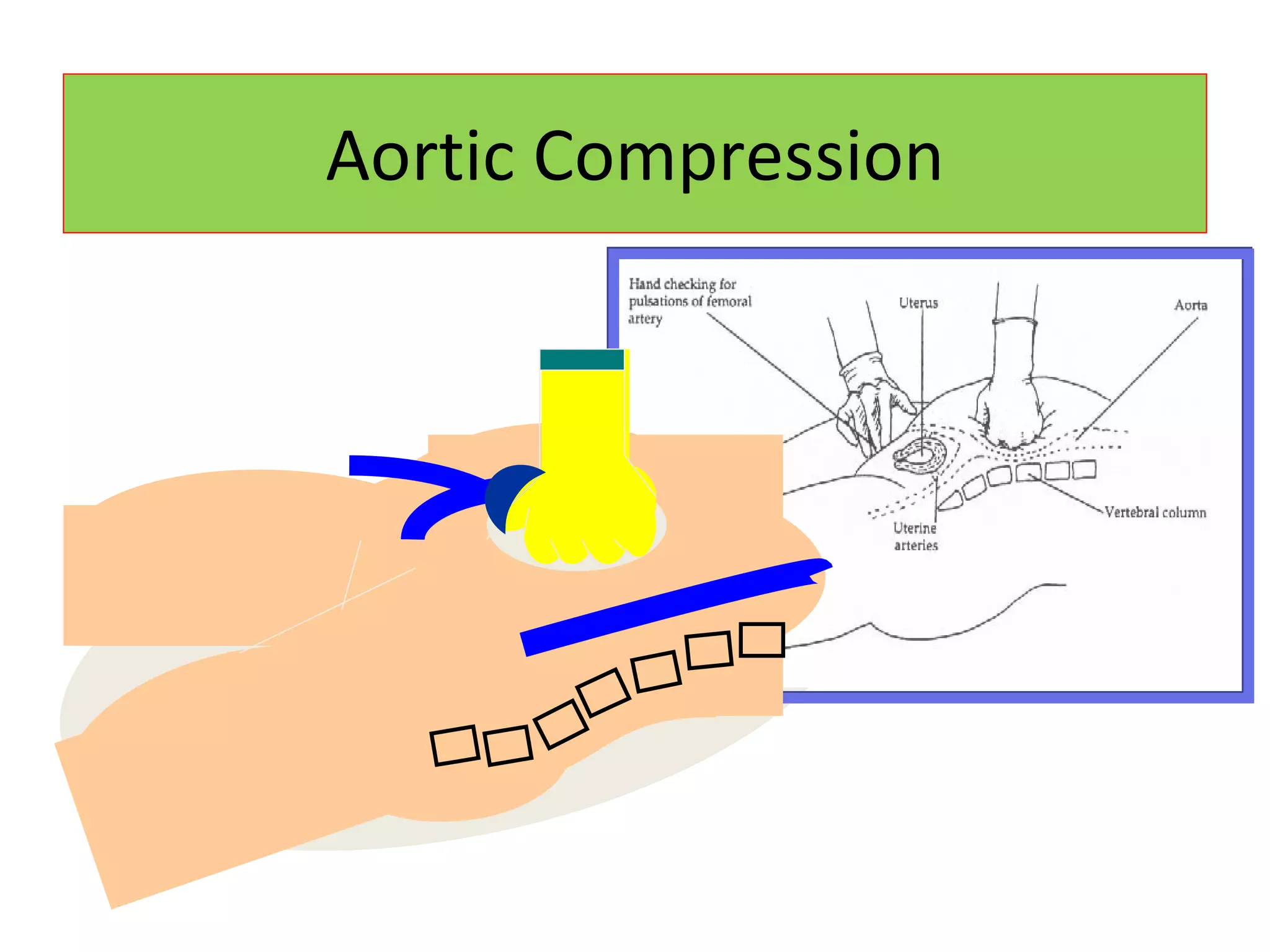 Aortic Compression 