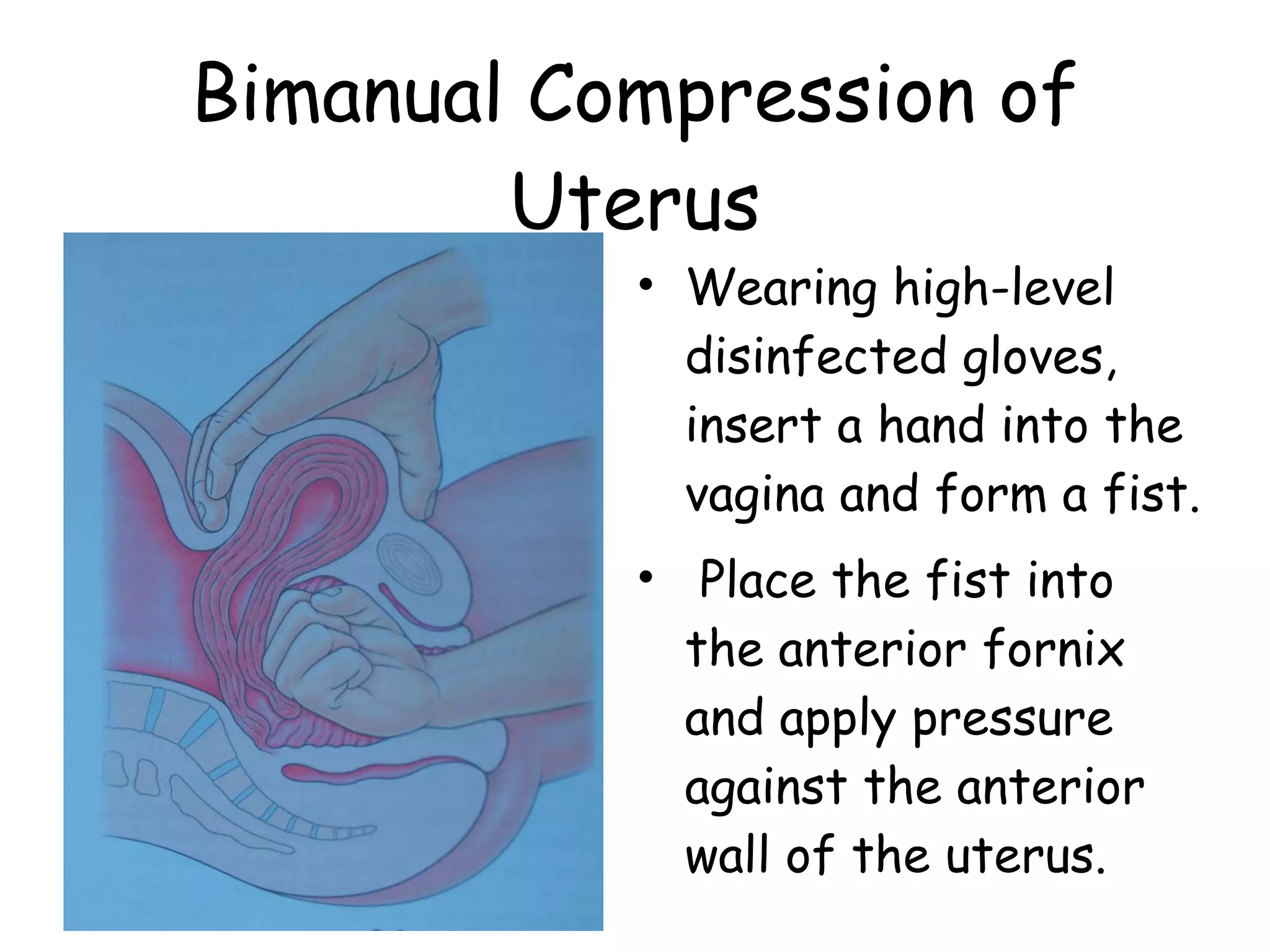 Bimanual Compression of Uterus Wearing high-level disinfected gloves, insert a hand into the vagina and form a fist. Place the fist into the anterior fornix and apply pressure against the anterior wall of the uterus.  