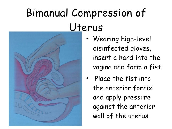 NonSurgical Management of PPH
