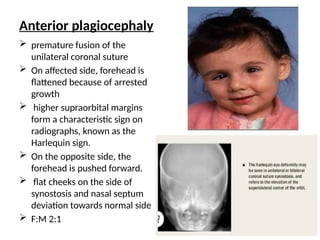 Anterior plagiocephaly
 premature fusion of the
unilateral coronal suture
 On affected side, forehead is
flattened because of arrested
growth
 higher supraorbital margins
form a characteristic sign on
radiographs, known as the
Harlequin sign.
 On the opposite side, the
forehead is pushed forward.
 flat cheeks on the side of
synostosis and nasal septum
deviation towards normal side
 F:M 2:1
 