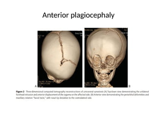 Anterior plagiocephaly
 