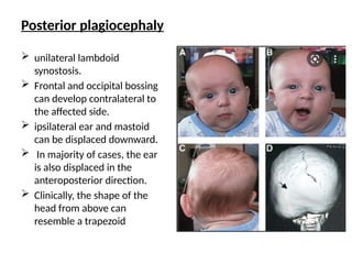 Posterior plagiocephaly
 unilateral lambdoid
synostosis.
 Frontal and occipital bossing
can develop contralateral to
the affected side.
 ipsilateral ear and mastoid
can be displaced downward.
 In majority of cases, the ear
is also displaced in the
anteroposterior direction.
 Clinically, the shape of the
head from above can
resemble a trapezoid
 