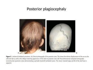 Posterior plagiocephaly
 