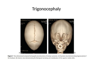 Trigonocephaly
 