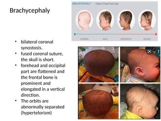 Brachycephaly
• bilateral coronal
synostosis.
• fused coronal suture,
the skull is short.
• forehead and occipital
part are flattened and
the frontal bone is
prominent and
elongated in a vertical
direction.
• The orbits are
abnormally separated
(hypertelorism)
 