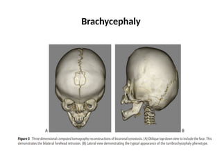 Brachycephaly
 