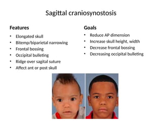 Sagittal craniosynostosis
Features
• Elongated skull
• Bitemp/biparietal narrowing
• Frontal bossing
• Occipital bulleting
• Ridge over sagital suture
• Affect ant or post skull
Goals
• Reduce AP dimension
• Increase skull height, width
• Decrease frontal bossing
• Decreasing occipital bulleting
 