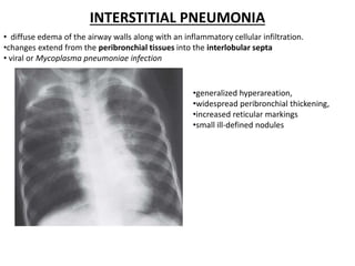 INTERSTITIAL PNEUMONIA
• diffuse edema of the airway walls along with an inflammatory cellular infiltration.
•changes extend from the peribronchial tissues into the interlobular septa
• viral or Mycoplasma pneumoniae infection
•generalized hyperareation,
•widespread peribronchial thickening,
•increased reticular markings
•small ill-defined nodules
 