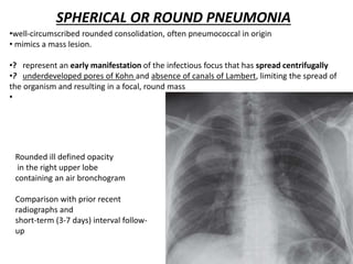 SPHERICAL OR ROUND PNEUMONIA
•well-circumscribed rounded consolidation, often pneumococcal in origin
• mimics a mass lesion.
•? represent an early manifestation of the infectious focus that has spread centrifugally
•? underdeveloped pores of Kohn and absence of canals of Lambert, limiting the spread of
the organism and resulting in a focal, round mass
•
Rounded ill defined opacity
in the right upper lobe
containing an air bronchogram
Comparison with prior recent
radiographs and
short-term (3-7 days) interval follow-
up
 