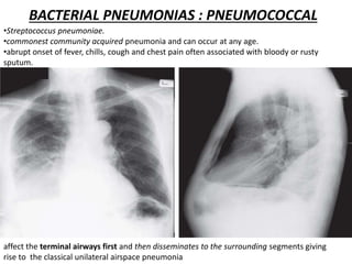 BACTERIAL PNEUMONIAS : PNEUMOCOCCAL
•Streptococcus pneumoniae.
•commonest community acquired pneumonia and can occur at any age.
•abrupt onset of fever, chills, cough and chest pain often associated with bloody or rusty
sputum.
affect the terminal airways first and then disseminates to the surrounding segments giving
rise to the classical unilateral airspace pneumonia
 
