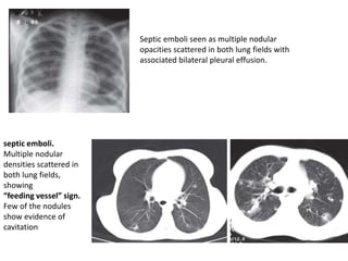 Septic emboli seen as multiple nodular
opacities scattered in both lung fields with
associated bilateral pleural effusion.
septic emboli.
Multiple nodular
densities scattered in
both lung fields,
showing
“feeding vessel” sign.
Few of the nodules
show evidence of
cavitation
 