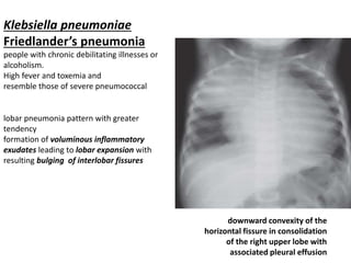 downward convexity of the
horizontal fissure in consolidation
of the right upper lobe with
associated pleural effusion
Klebsiella pneumoniae
Friedlander’s pneumonia
people with chronic debilitating illnesses or
alcoholism.
High fever and toxemia and
resemble those of severe pneumococcal
lobar pneumonia pattern with greater
tendency
formation of voluminous inflammatory
exudates leading to lobar expansion with
resulting bulging of interlobar fissures
 