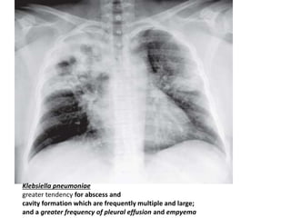 Klebsiella pneumoniae
greater tendency for abscess and
cavity formation which are frequently multiple and large;
and a greater frequency of pleural effusion and empyema
 