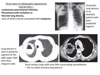 Three types of radiographic appearances
may be seen—
• pulmonary parenchymal infection,
•Pneumonia with cavitation or
•discrete lung abscess,
each of which may be associated with empyema.
Anaerobic
lung abscess
in an
alcoholic
patient with
poor
orodental
hygiene
Lung abscess is
seen in posterior
segment of the
right upper lobe
with thick
irregular walls focal cavitary mass with very little surrounding consolidation
– the so called ‘primary lung abscess’
 