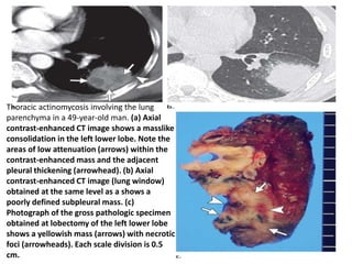 Thoracic actinomycosis involving the lung
parenchyma in a 49-year-old man. (a) Axial
contrast-enhanced CT image shows a masslike
consolidation in the left lower lobe. Note the
areas of low attenuation (arrows) within the
contrast-enhanced mass and the adjacent
pleural thickening (arrowhead). (b) Axial
contrast-enhanced CT image (lung window)
obtained at the same level as a shows a
poorly defined subpleural mass. (c)
Photograph of the gross pathologic specimen
obtained at lobectomy of the left lower lobe
shows a yellowish mass (arrows) with necrotic
foci (arrowheads). Each scale division is 0.5
cm.
 