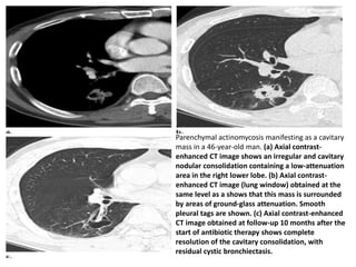Parenchymal actinomycosis manifesting as a cavitary
mass in a 46-year-old man. (a) Axial contrast-
enhanced CT image shows an irregular and cavitary
nodular consolidation containing a low-attenuation
area in the right lower lobe. (b) Axial contrast-
enhanced CT image (lung window) obtained at the
same level as a shows that this mass is surrounded
by areas of ground-glass attenuation. Smooth
pleural tags are shown. (c) Axial contrast-enhanced
CT image obtained at follow-up 10 months after the
start of antibiotic therapy shows complete
resolution of the cavitary consolidation, with
residual cystic bronchiectasis.
 