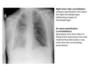 Right lower lobe consolidation
airspace opacification that abuts
the right hemidiaphragm,
obliterating margin of
hemidiaphragm
Air space opacification
(=consolidation)
descriptive term that refers to
filling of the pulmonary tree with
material that attenuates x-rays
more than the surrounding
parenchyma
 