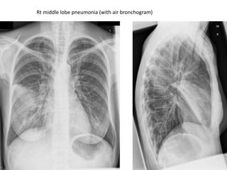 Rt middle lobe pneumonia (with air bronchogram)
 