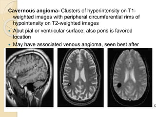 Circumferential Rims Non traumatic haemorrhage | PPTX