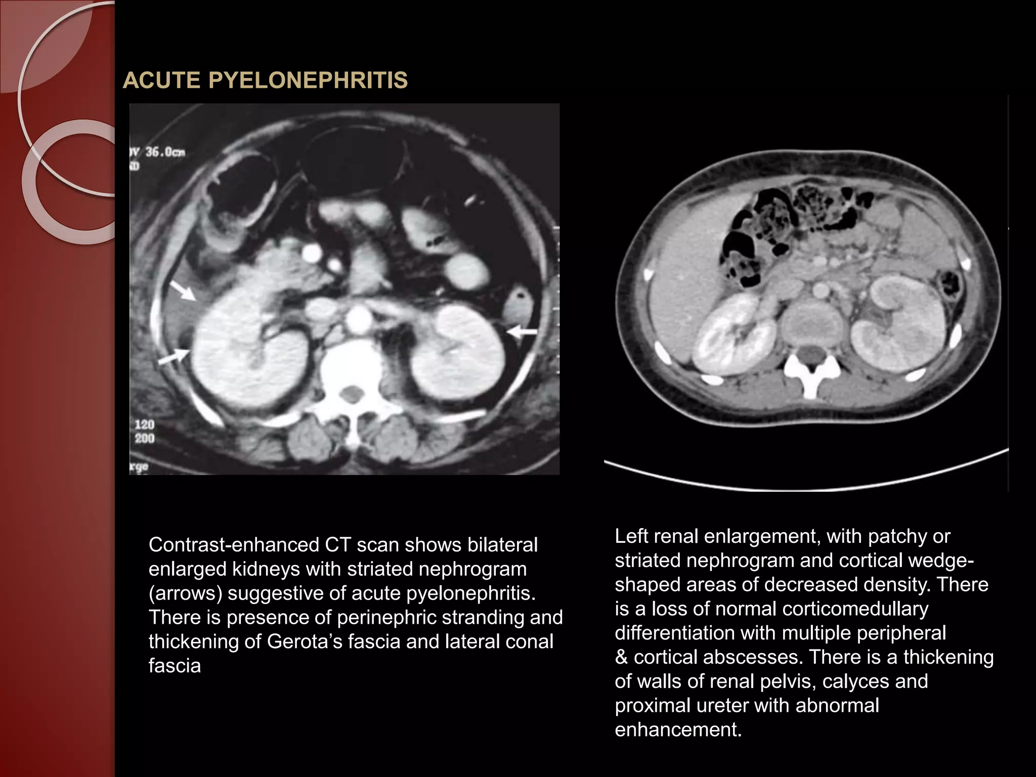 Imaging of Non tubercular infections of the urinary tract | PPTX