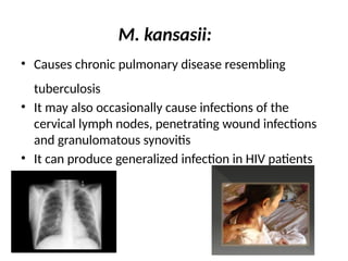 M. kansasii:
• Causes chronic pulmonary disease resembling
tuberculosis
• It may also occasionally cause infections of the
cervical lymph nodes, penetrating wound infections
and granulomatous synovitis
• It can produce generalized infection in HIV patients
 