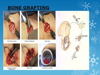 BONE GRAFTING
 