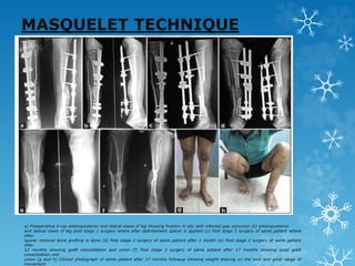 MASQUELET TECHNIQUE
a) Preoperative X-ray anteroposterior and lateral views of leg showing fixation in situ with infected gap nonunion (b) anteroposterior
and lateral views of leg post stage 1 surgery where after debridement spacer is applied (c) Post stage 2 surgery of same patient where
after
spacer removal bone grafting is done (d) Post stage 2 surgery of same patient after 1 month (e) Post stage 2 surgery of same patient
after
12 months showing graft consolidation and union (f) Post stage 2 surgery of same patient after 17 months showing good graft
consolidation and
union (g and h) Clinical photograph of same patient after 17 months followup showing weight bearing on the limb and good range of
movement
 