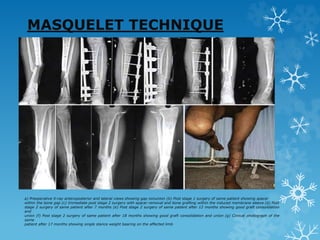 MASQUELET TECHNIQUE
a) Preoperative X-ray anteroposterior and lateral views showing gap nonunion (b) Post stage 1 surgery of same patient showing spacer
within the bone gap (c) Immediate post stage 2 surgery with spacer removal and bone grafting within the induced membrane sleeve (d) Post
stage 2 surgery of same patient after 7 months (e) Post stage 2 surgery of same patient after 12 months showing good graft consolidation
and
union (f) Post stage 2 surgery of same patient after 18 months showing good graft consolidation and union (g) Clinical photograph of the
same
patient after 17 months showing single stance weight bearing on the affected limb
 