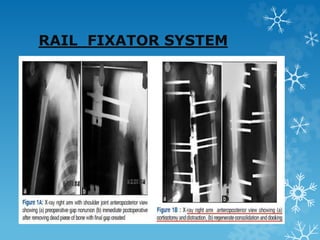 RAIL FIXATOR SYSTEM
 