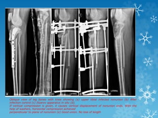 Oblique view of leg bones with knee showing (a) upper tibial infected nonunion (b) After
infection control (c) Ilizarov apparatus in situ (d).
If vertical compression is given, it causes vertical displacement of nonunion ends. With the
help of washers, horizontal compression achieved
perpendicular to plane of nonunion (e) Good union. No loss of length
 