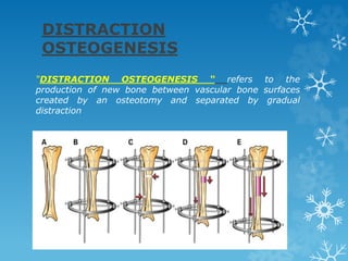 DISTRACTION
OSTEOGENESIS
“DISTRACTION OSTEOGENESIS “ refers to the
production of new bone between vascular bone surfaces
created by an osteotomy and separated by gradual
distraction
 