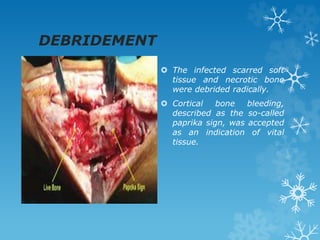 DEBRIDEMENT
 The infected scarred soft
tissue and necrotic bone
were debrided radically.
 Cortical bone bleeding,
described as the so-called
paprika sign, was accepted
as an indication of vital
tissue.
 