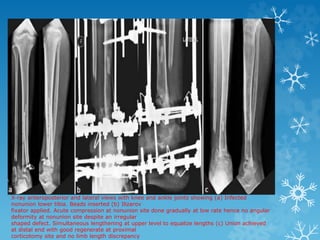 X-ray anteroposterior and lateral views with knee and ankle joints showing (a) Infected
nonunion lower tibia. Beads inserted (b) Ilizarov
fixator applied. Acute compression at nonunion site done gradually at low rate hence no angular
deformity at nonunion site despite an irregular
shaped defect. Simultaneous lengthening at upper level to equalize lengths (c) Union achieved
at distal end with good regenerate at proximal
corticotomy site and no limb length discrepancy
 