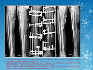 X-ray leg bones with knee joint anteroposterior and lateral views showing (a) Infected tibial
nonunion. Irregular bony ends. Had we
resected bone till achieving horizontal bony surfaces, it would have created a lot of
shortening (b) we gave compression at rate of one-fourth mm
twice a week to achieve compression but not cause an angular deviation. No bone grafting
done (c) Sound union, after ilizarov construct removal
 
