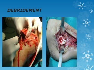 DEBRIDEMENT
 