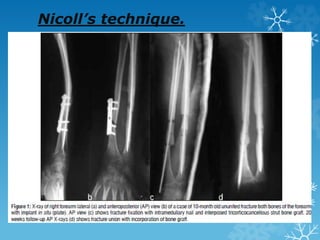 Nicoll’s technique.
 